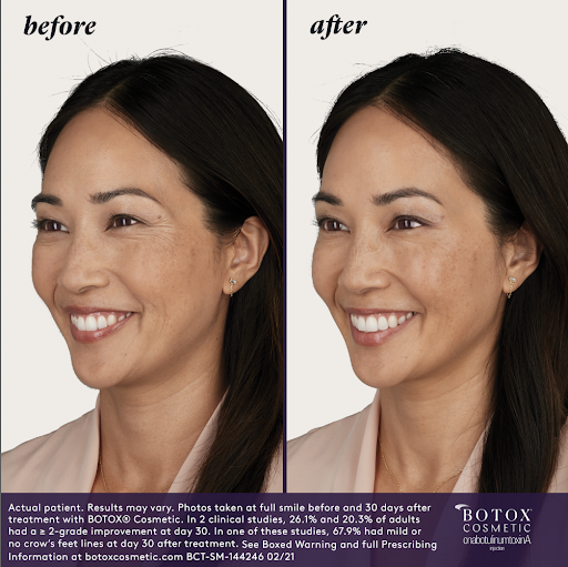 botox monsters Botox® By The Area – Alexandria Associates in Dermatology